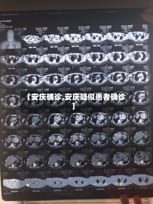 【安庆确诊,安庆疑似患者确诊】-第2张图片